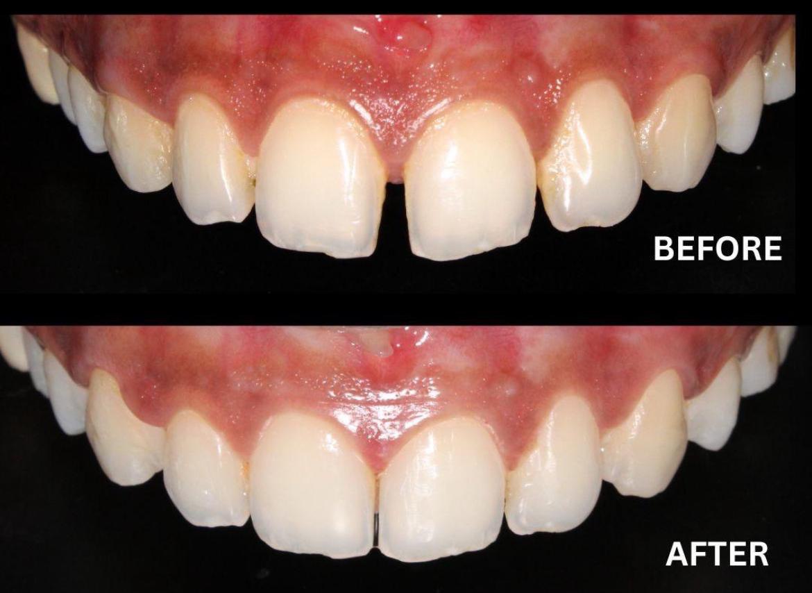 Smile Transformation Result 1